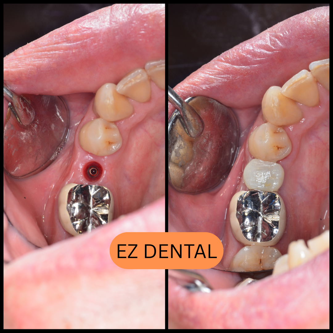 Dental Implant