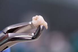 Wisdom tooth extraction