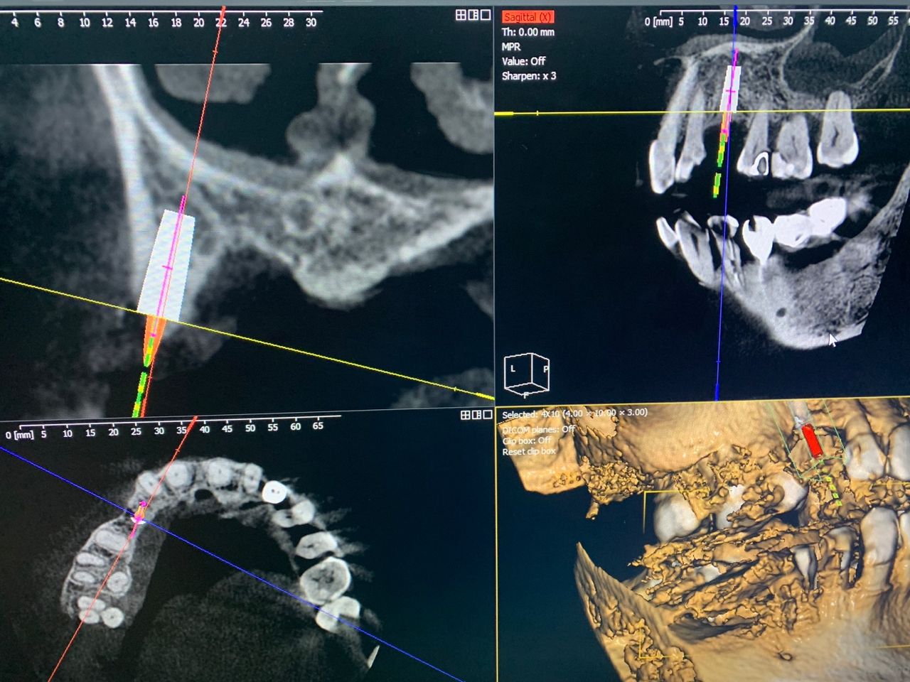 CBCT X-RAY