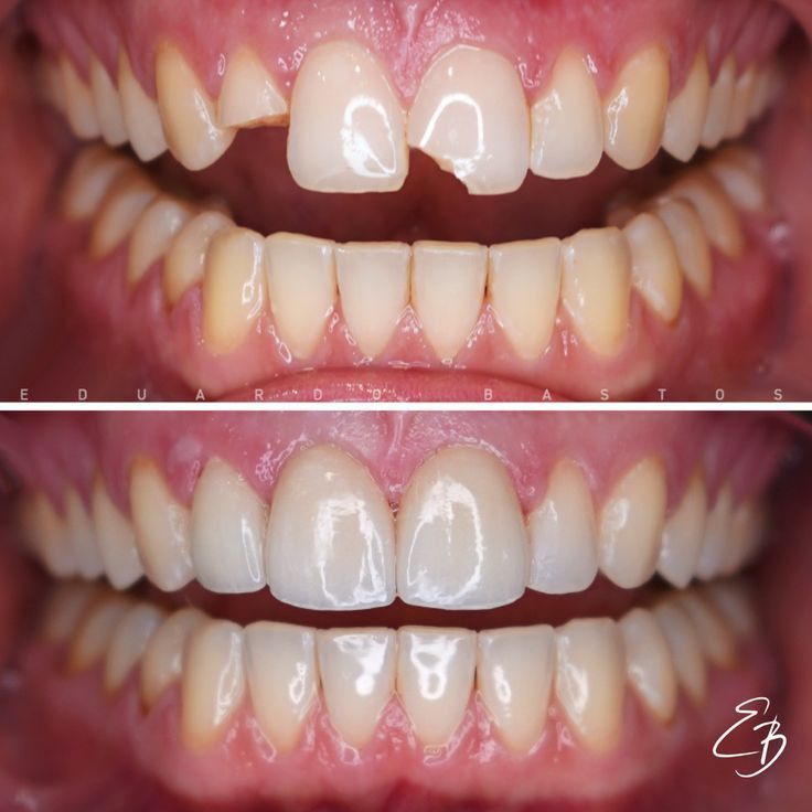 Aesthetic Tooth Filling Johor Bahru | Natural Look Dental Filling JB at Idea Dental (Mount Austin & Taman Pelangi)