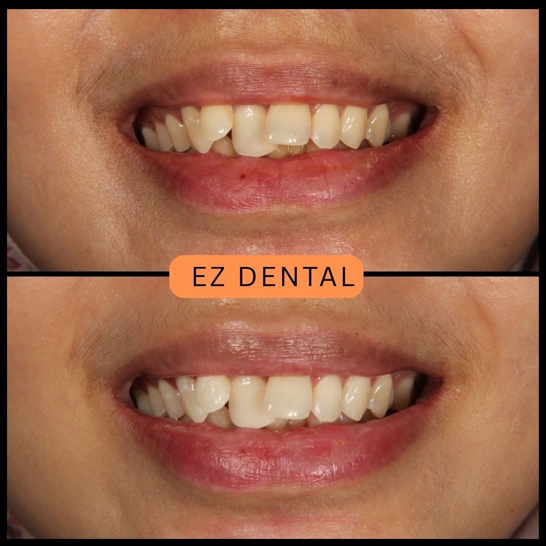 Teeth Whitening