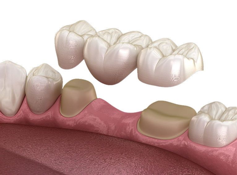 Dental Bridges