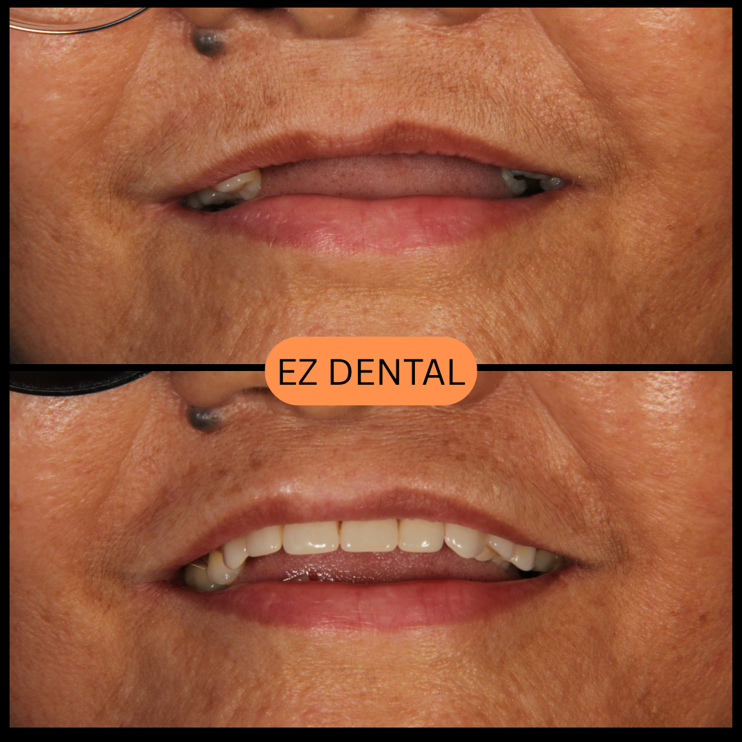 Denture