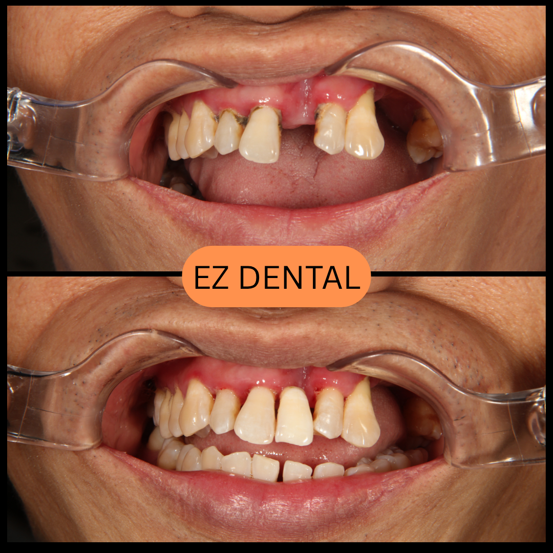 Crown | Bridge | Overlay