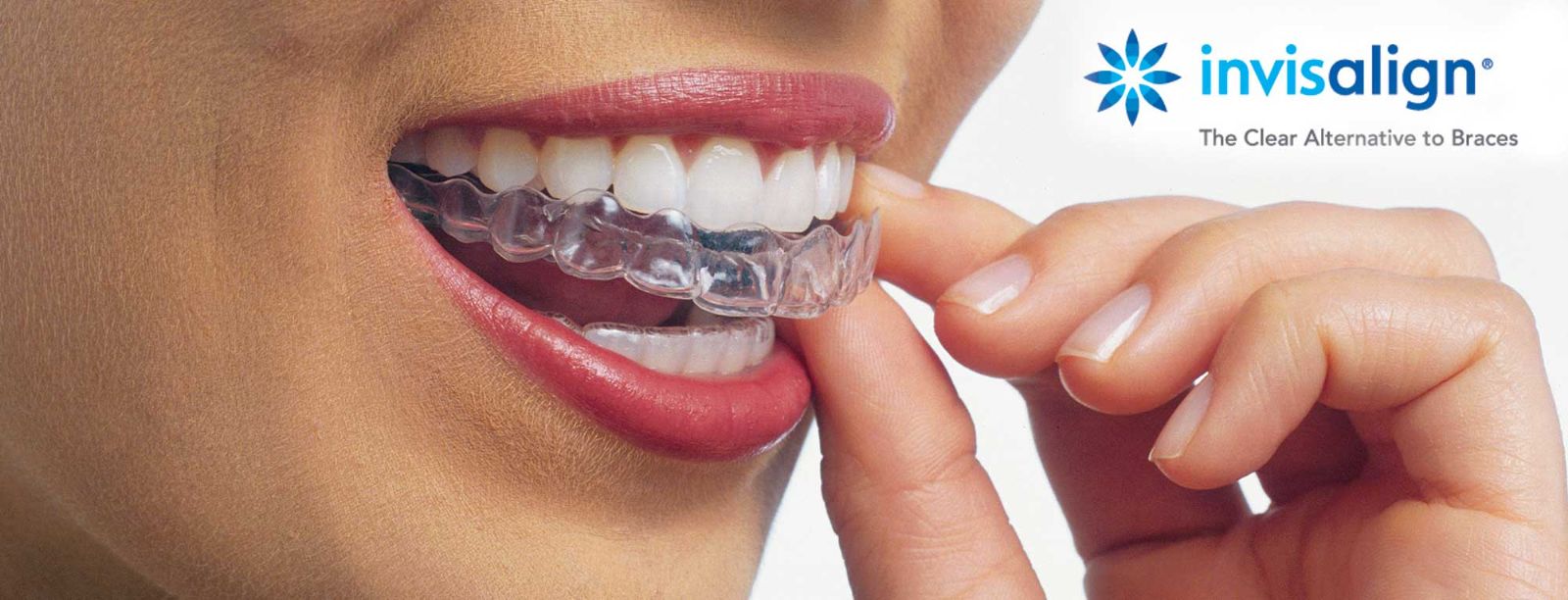 Clear Aligner