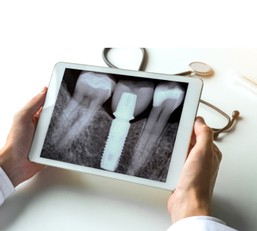 Dental X-Ray (IOPA)