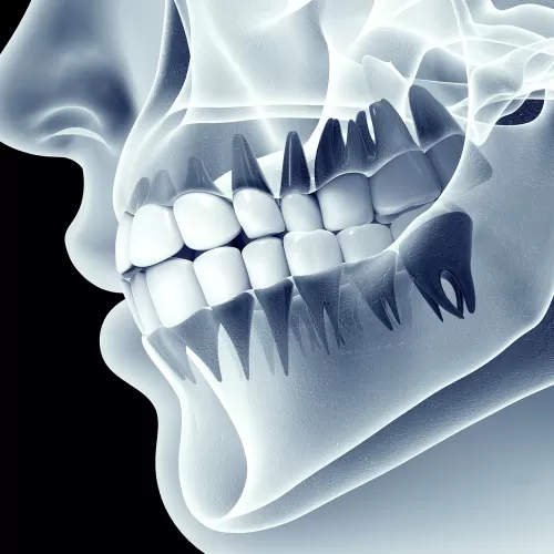 Dental X-Ray