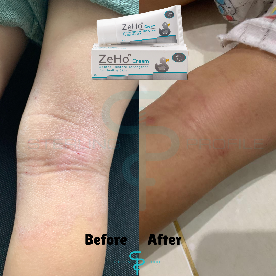 ZeHo MicroAg+ Cream Testimonial  & Sterling Profile Sdn Bhd