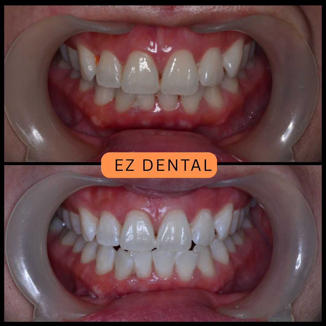 Teeth Whitening