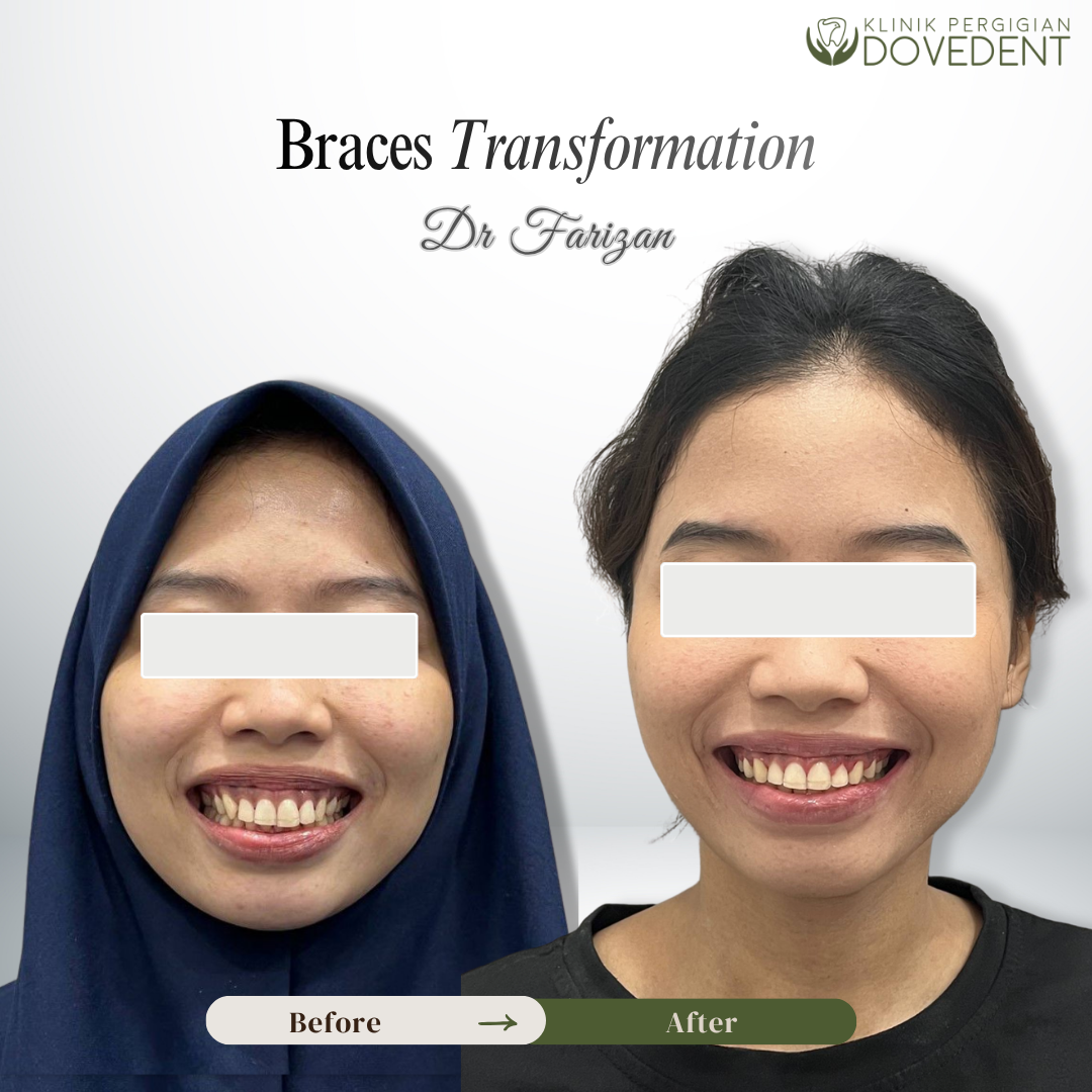 Braces Transformation