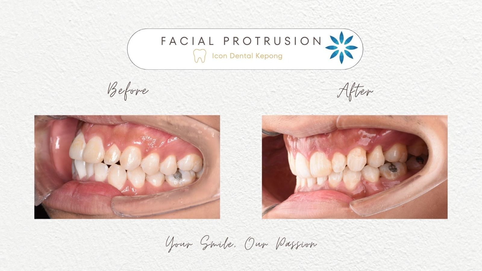 Invisalign