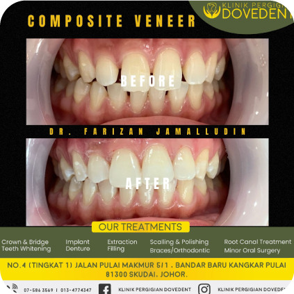 Composite Veneer's Logo