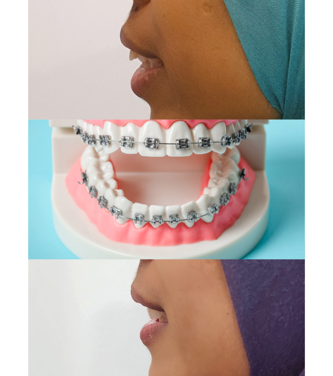 Braces (Installment Payment Method)