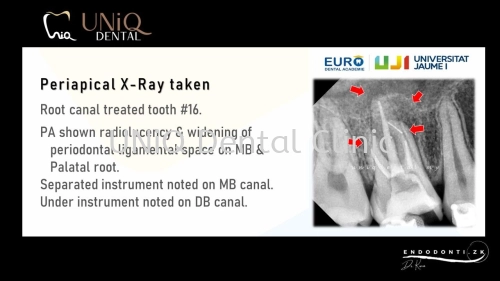 Root Canal Treatment