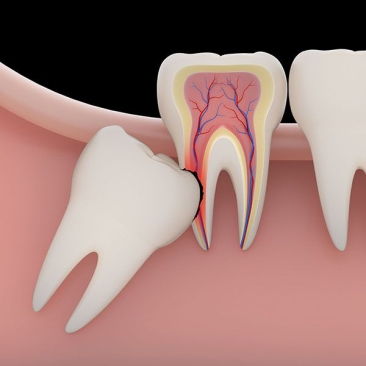 Impacted Wisdom Tooth