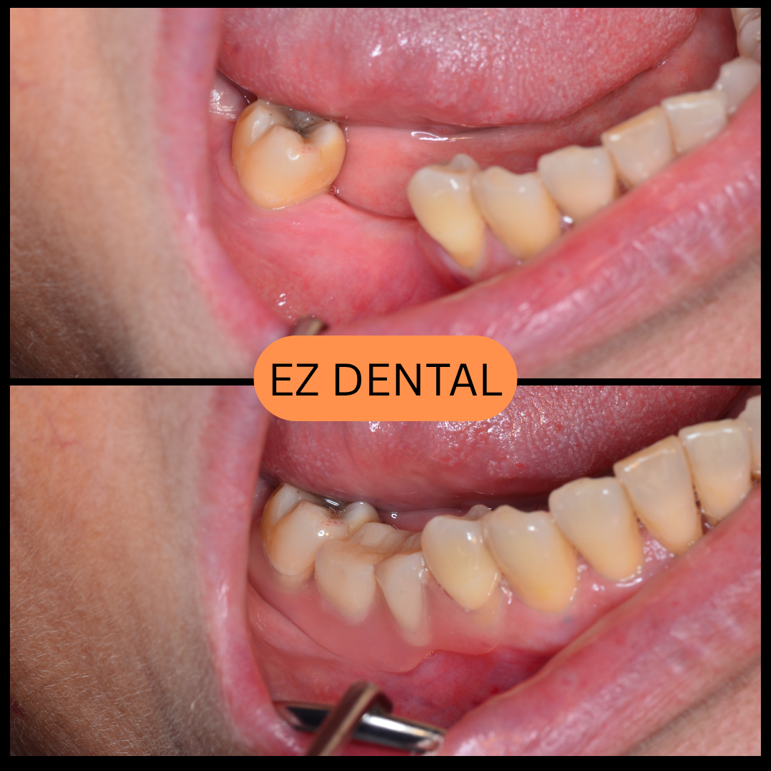 Denture