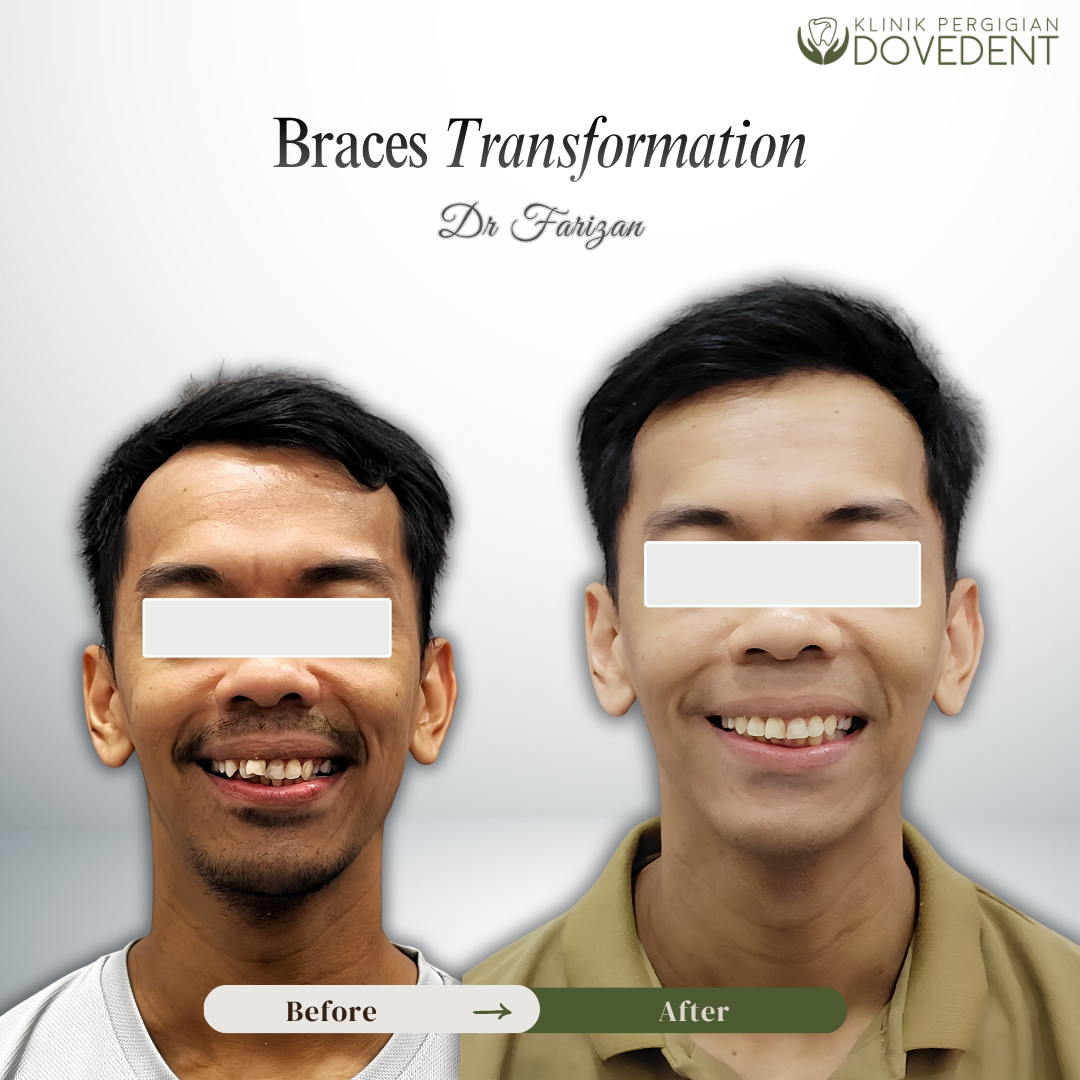 Braces Transformation
