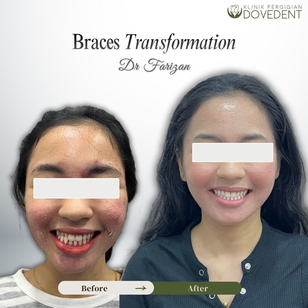 Smile Transformation