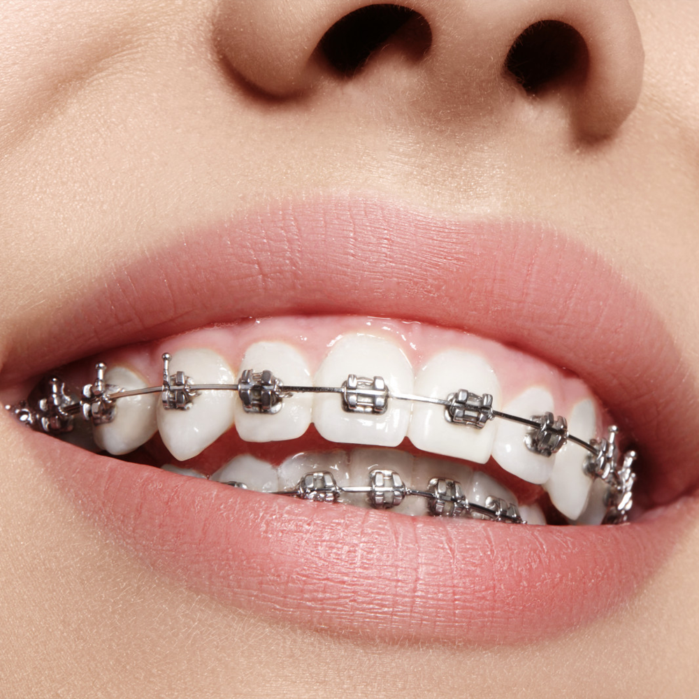 Braces / Orthodontic