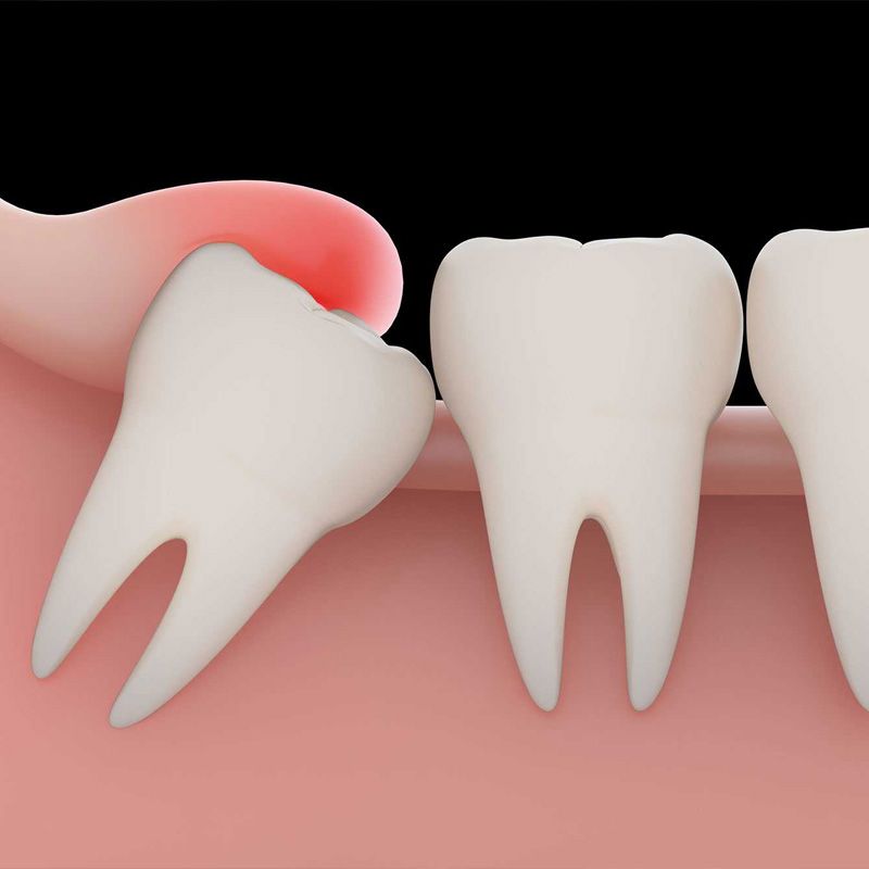 Impacted Wisdom Tooth Removal