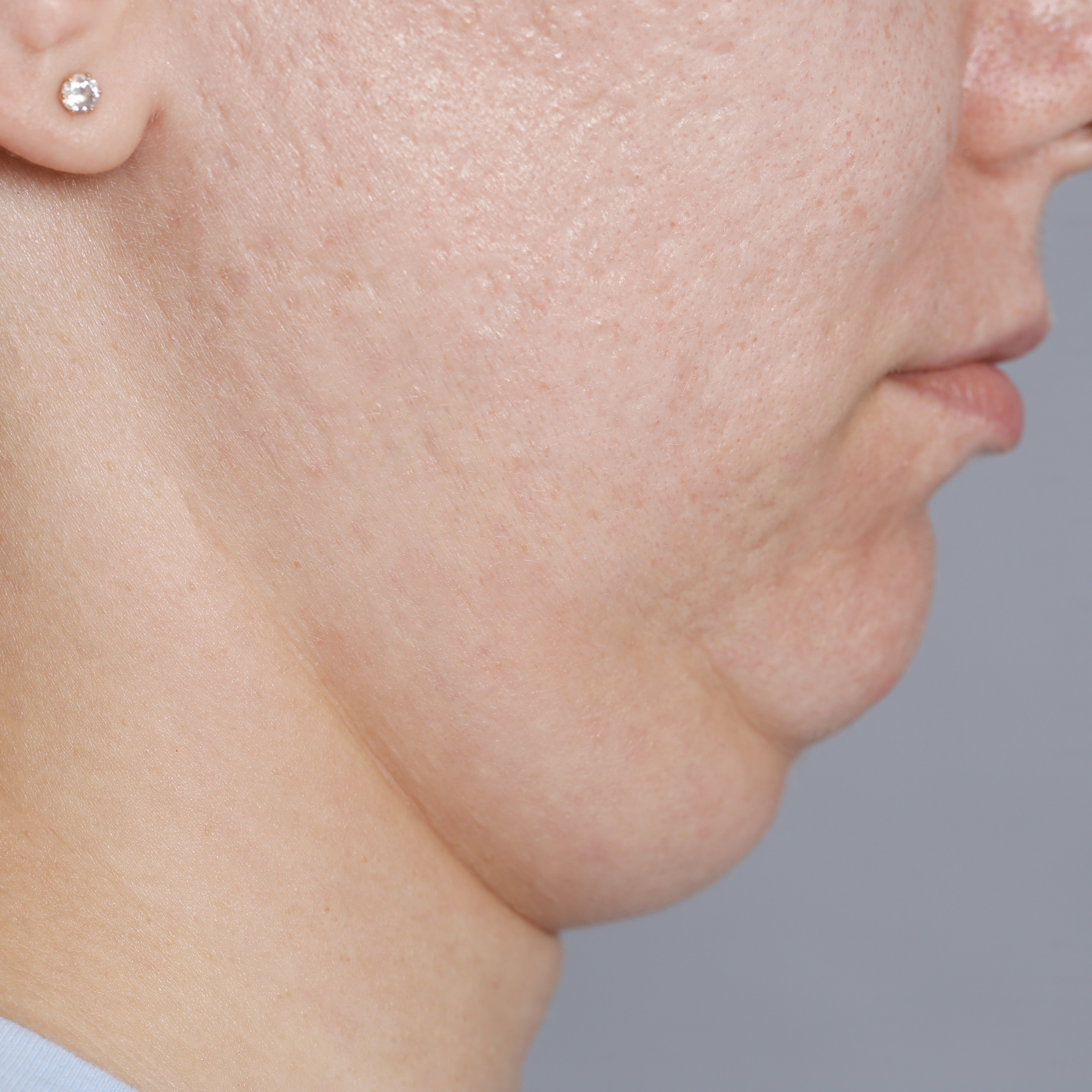Pronounced submental tissue pooling - Dr Wee Clinic
