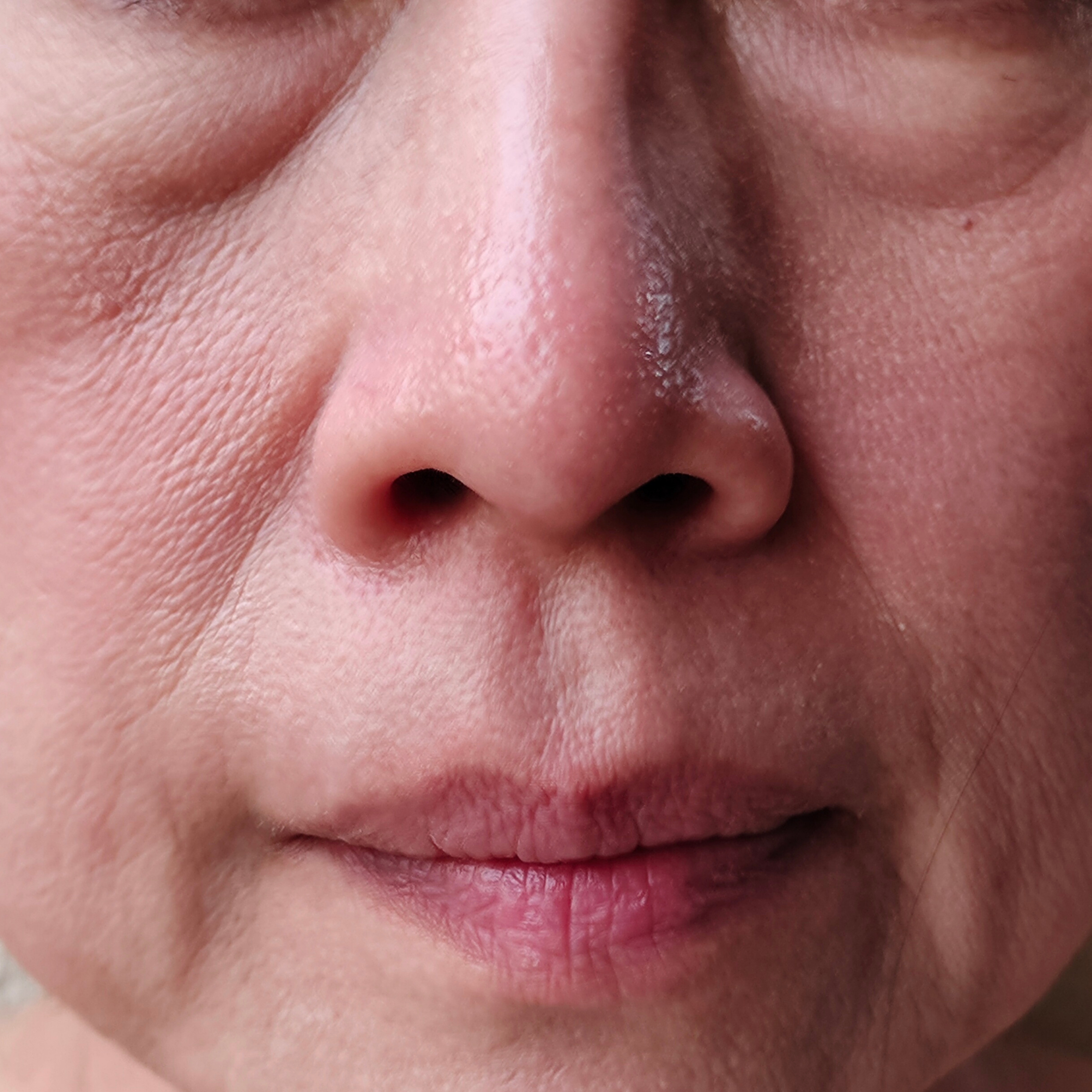 General facial tissue laxity - Dr Wee Clinic